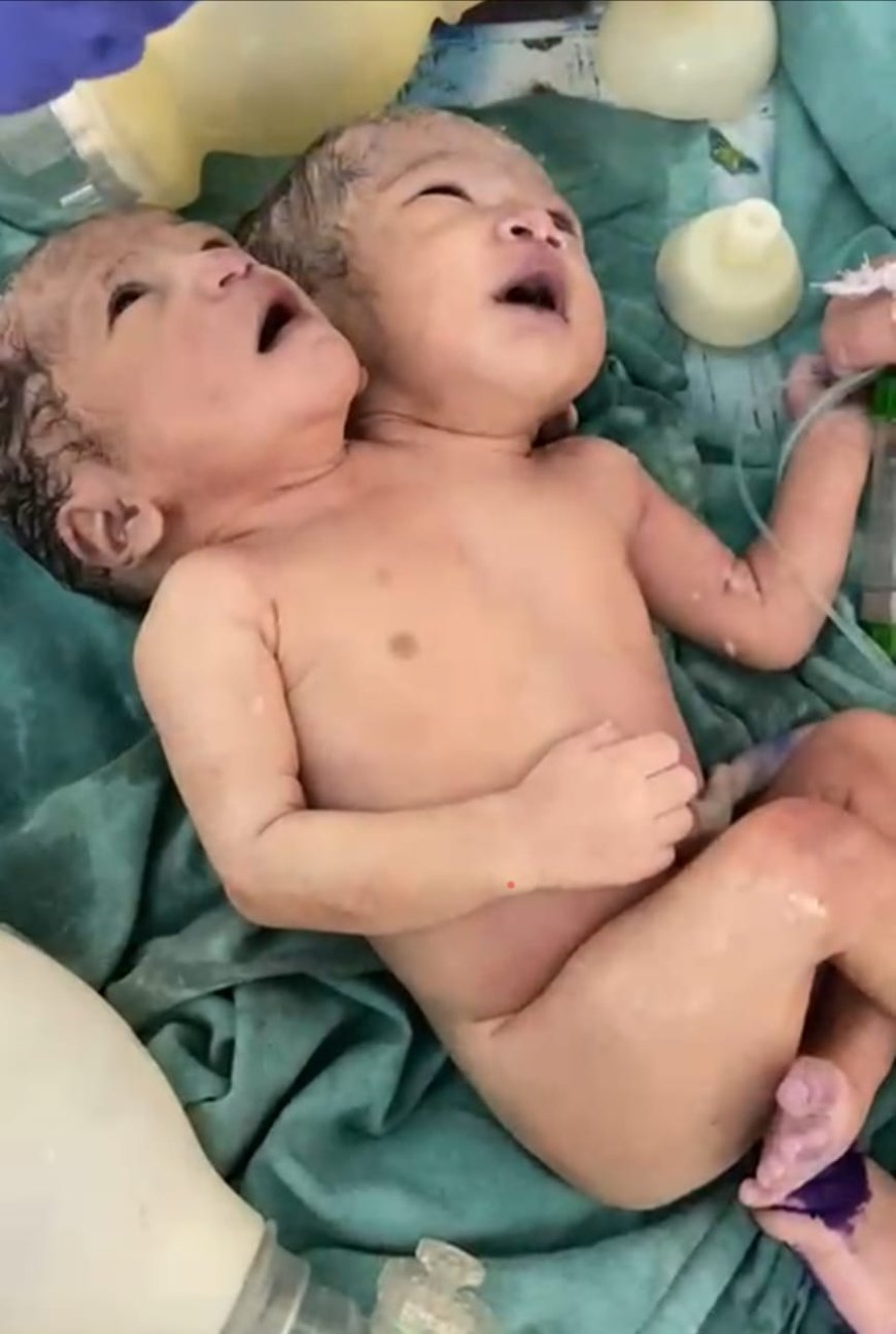 इंदौर शहर के MTH हॉस्पिटल में सिर से जुड़े जुड़वा बच्चों का जन्म